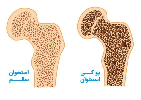 دوری از نور آفتاب؛ اصلی‌ترین عوامل خطر ابتلا به پوکی استخوان