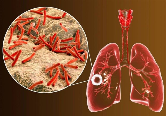 شایعترین علامت ابتلا به بیماری سل ریوی، سرفه پایدار است